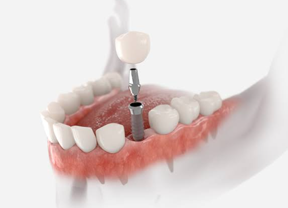 What to Settle Before You Price Dental Implants