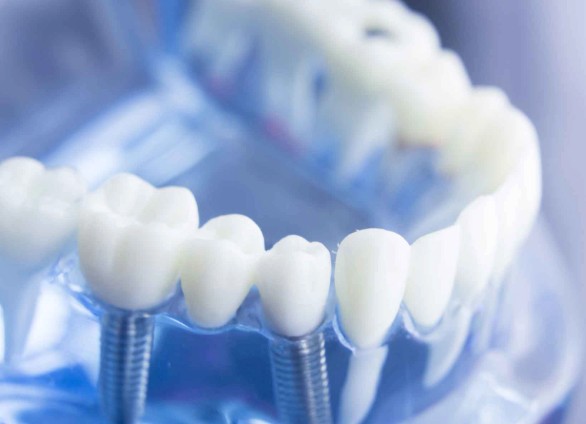 Choosing A Full-Arch Tooth Replacement Plan That Fits Daily Life