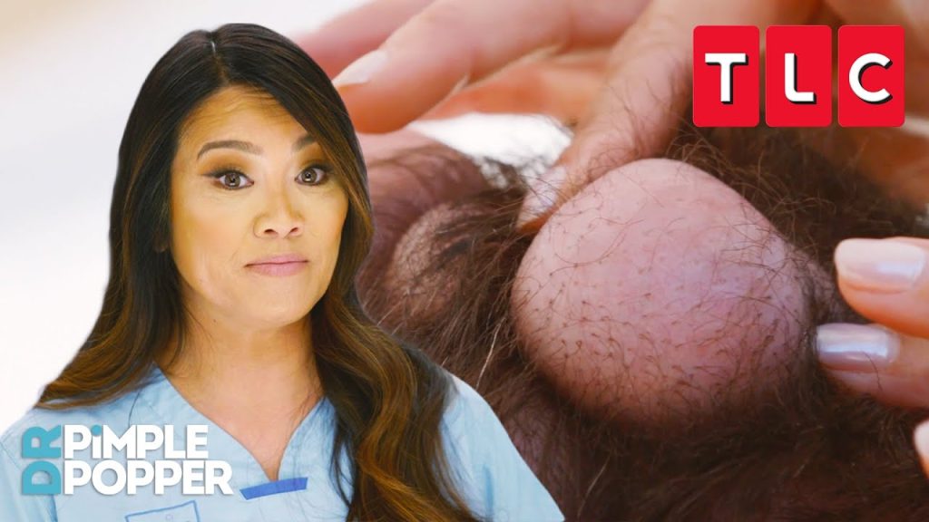 The Incredible Cyst Removal That Completely Surprised Dr. Pimple Popper